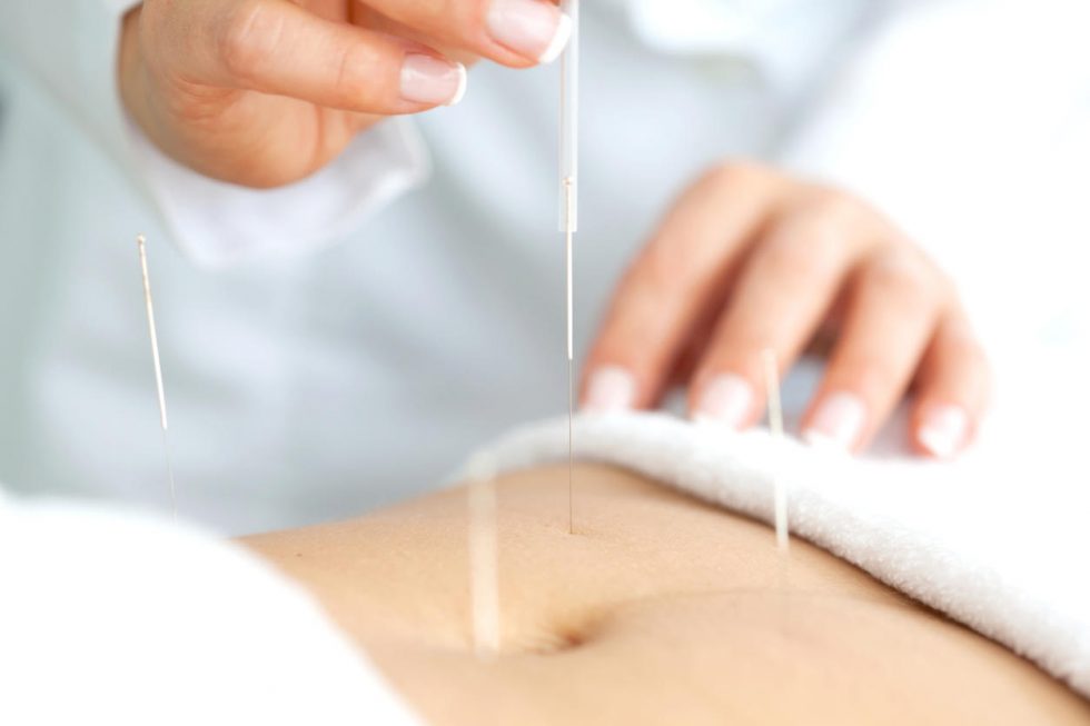 Fertility Acupuncture Doral Acupuncture
